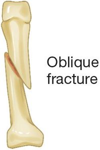 Oblique fracture illustration