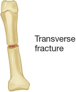 Transverse fracture illustration