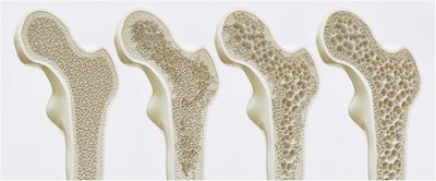Normal bone versus bone with osteoporosis, showing progressive demineralization