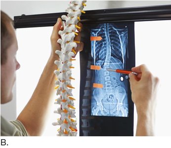 X-ray and model used to measure scoliosis