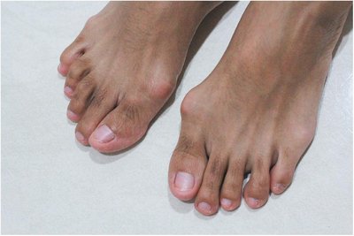 Hallux valgus and bunion