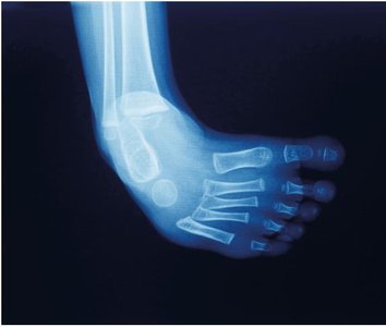 X-ray of clubfoot