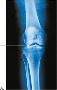 Normal knee joint x-ray