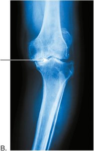 Knee joint with osteoarthritis, showing narrowed joint space and malalignment