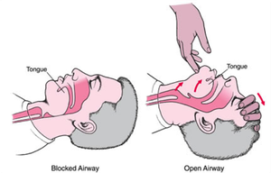 Blocked vs open airway diagram