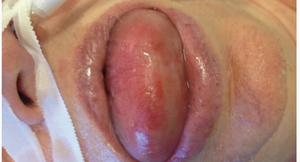 Severe tongue swelling causing airway obstruction