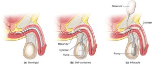 Penile implants: semirigid and inflatable