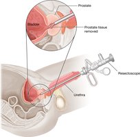 Transurethral resection of the prostate (TURP)