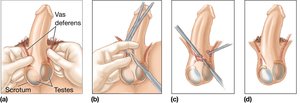 Vasectomy procedure