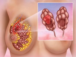 Breast cancer: infiltrating ductal carcinoma