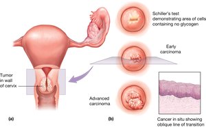 Stages of cervical cancer development