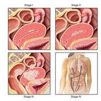 Stages of endometrial cancer