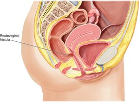 Rectovaginal fistula