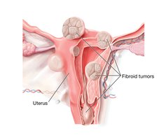 Fibroid tumors (leiomyomas)