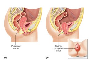 Prolapsed uterus