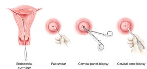 Gynecological biopsy procedures