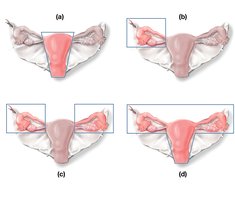 Types of uterine and adnexal surgeries