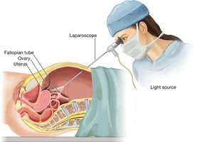 Laparoscopy for reproductive organs