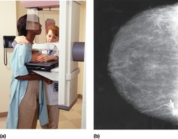 Mammography procedure and image