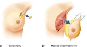 Breast surgery: lumpectomy and mastectomy