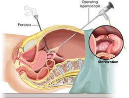 Tubal ligation procedure