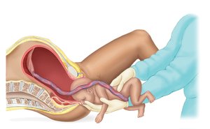 Breech presentation