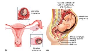 Ectopic pregnancy locations