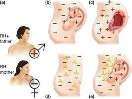 Erythroblastosis fetalis mechanism
