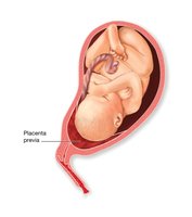 Placenta previa