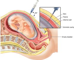 Amniocentesis procedure