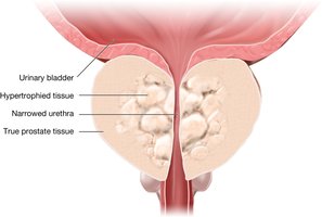 Benign prostatic hyperplasia (BPH)