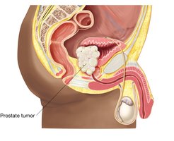 Prostate cancer with tumor invading bladder