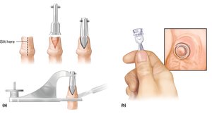 Circumcision procedures