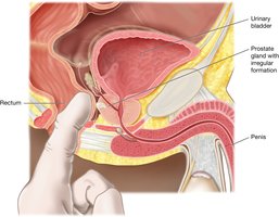 Digital rectal examination (DRE)
