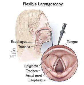 Flexible laryngoscopy showing vocal cords