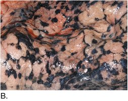 Lung tissue with tar deposits from smoking