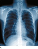 Normal chest x-ray