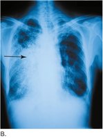 Chest x-ray showing pneumonia
