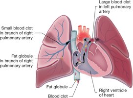 Pulmonary embolus blocking blood flow in the lungs