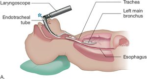 Endotracheal intubation procedure