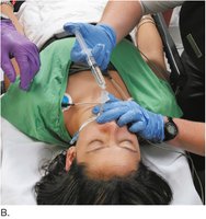 Endotracheal tube connected to respirator