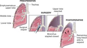 Lobectomy procedure steps