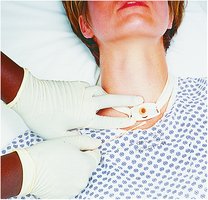 Patient with tracheostomy tube