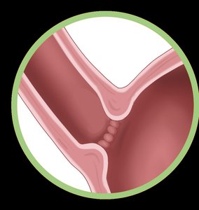 Cardiac sphincter