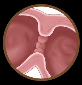 Pyloric sphincter