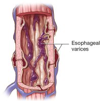 Esophageal varices in the esophagus