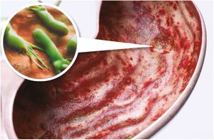 Gastric ulcer with inflamed mucosa