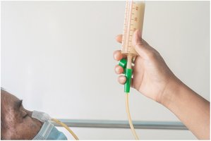 Nasogastric tube feeding