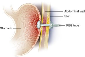 PEG tube placement through abdominal wall