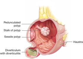 Diverticulitis and polyps in the colon